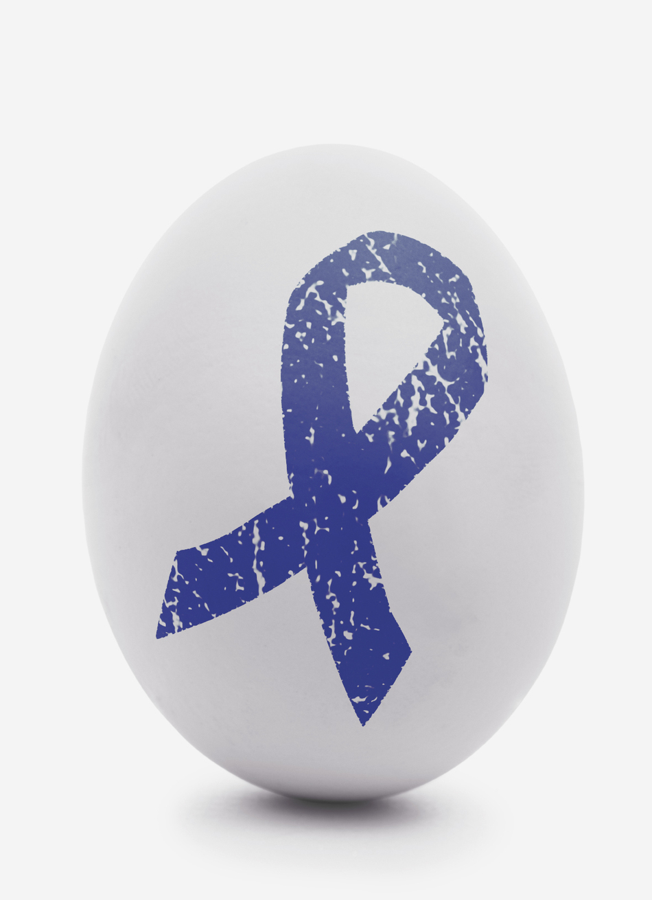 Removing Ovaries Might Increase the Risk of Colon Cancer