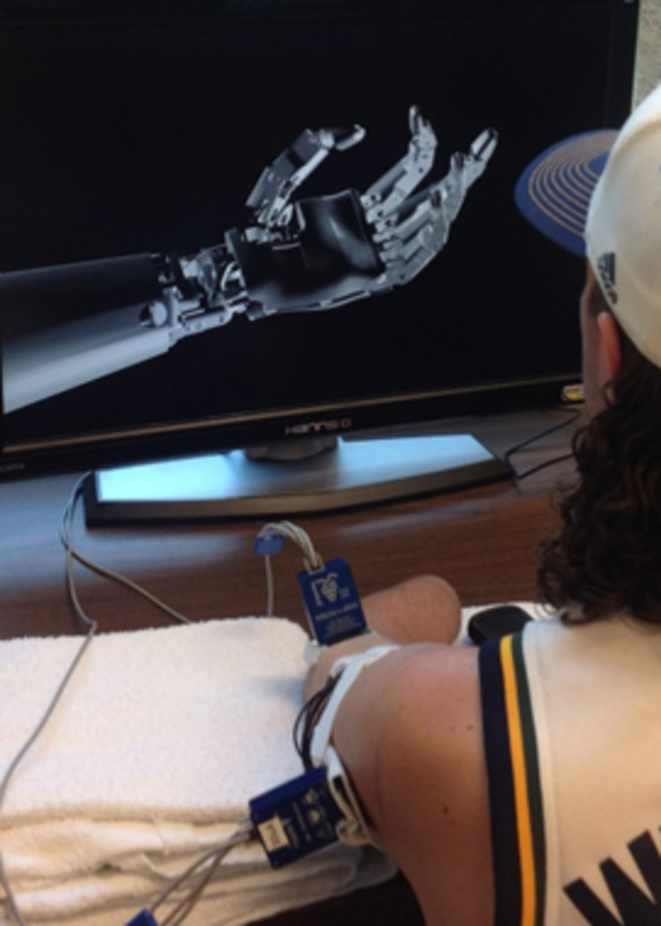 A Prosthetic Hand that Moves & Feels