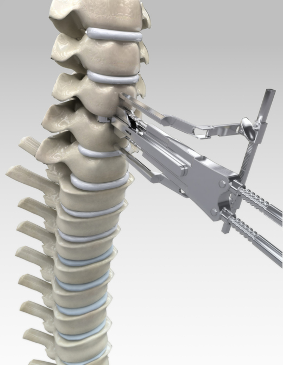 What to Expect When Treating Spinal Scoliosis with Surgery