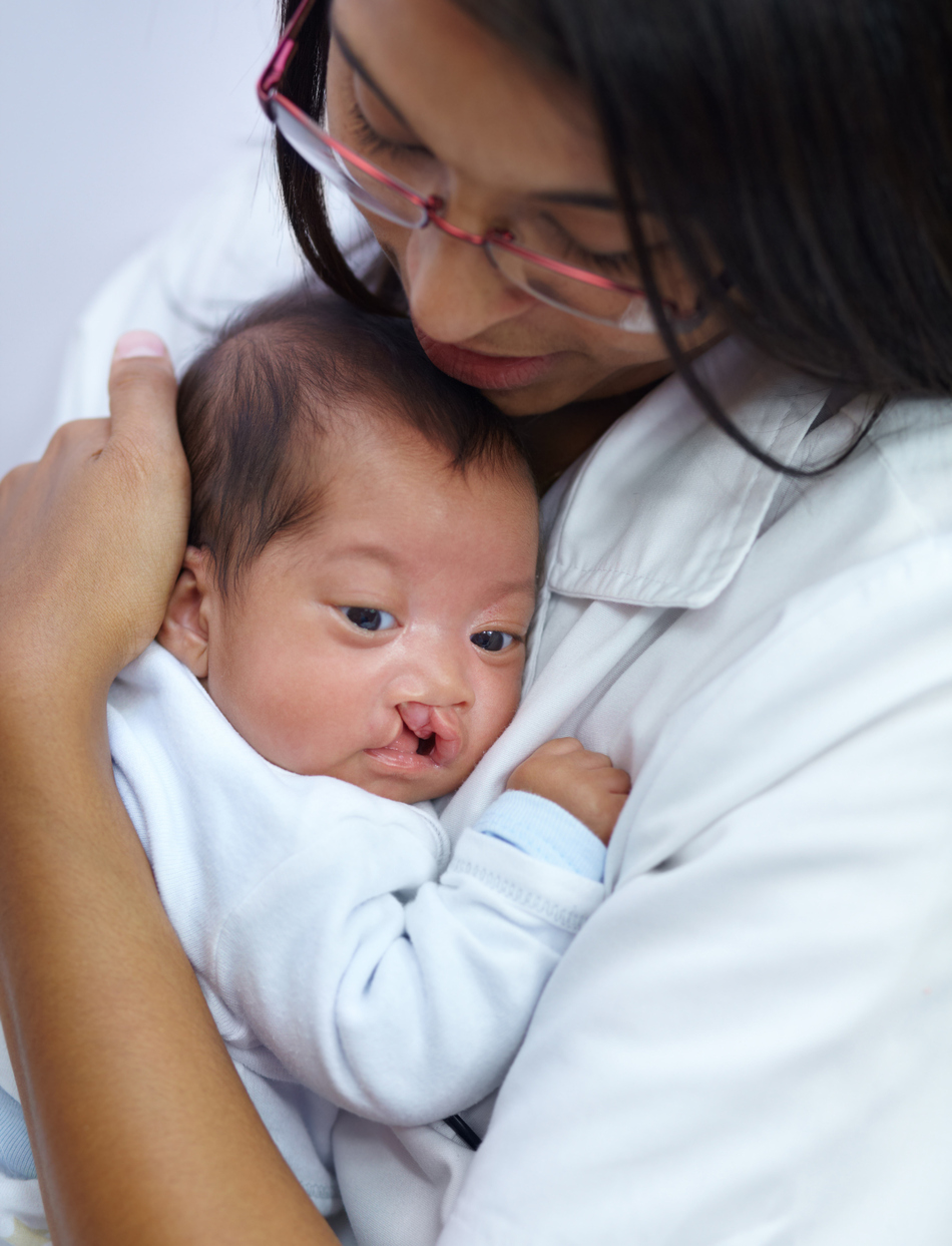 New Strategy May Reduce Amount of Lifetime Cleft Palate Operations