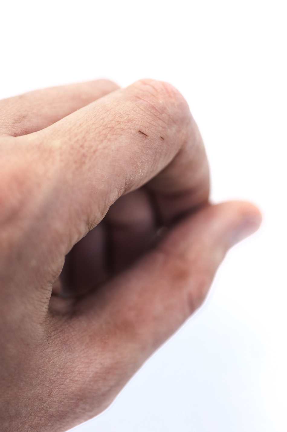 Best Way to Remove a Splinter