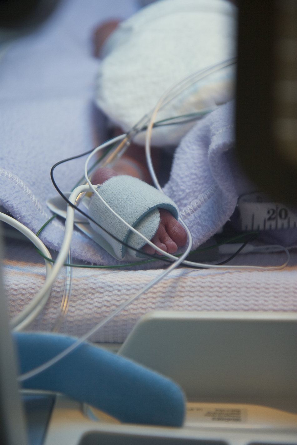 Care for Very Premature Babies Improved, but Preterm Births Still Common