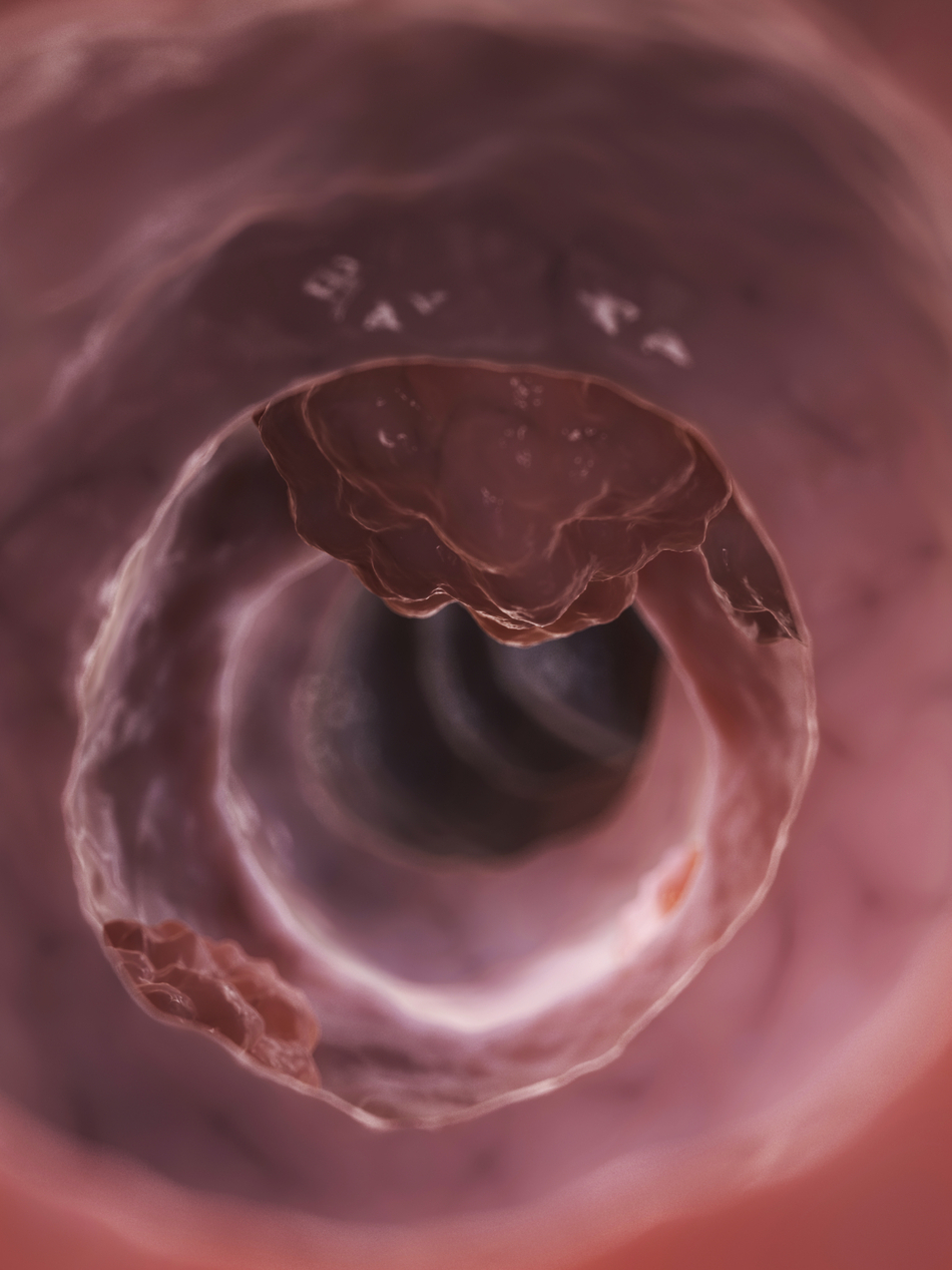 Drug Treatment Prevents Polyps In High-Risk Cancer Patients