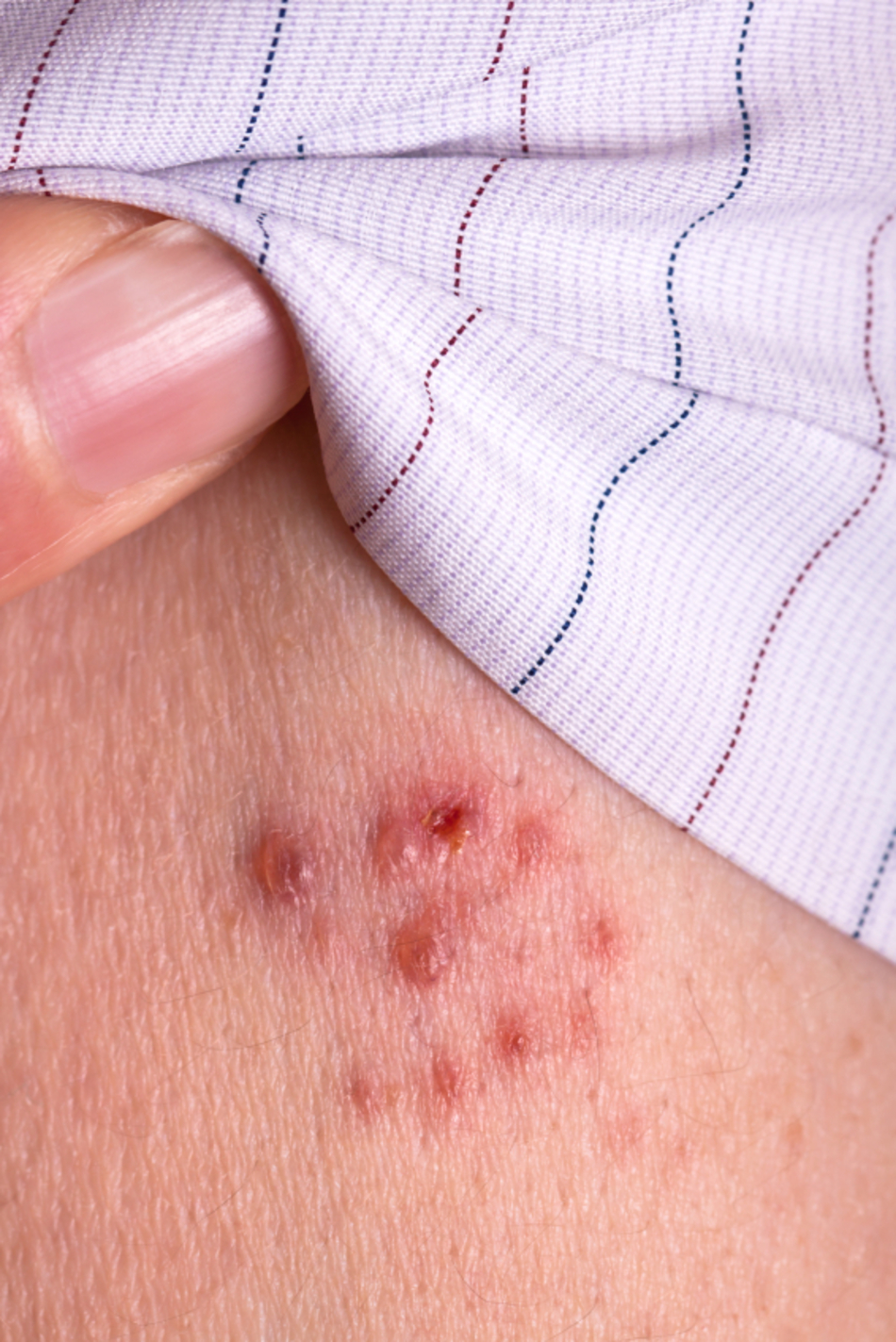 Why You Need a Shingles Shot