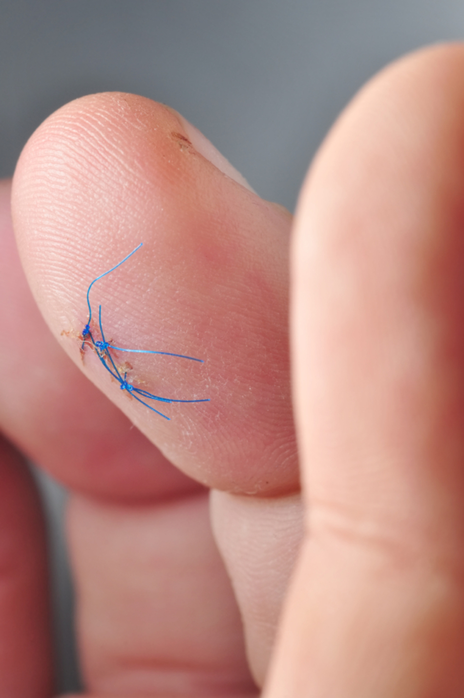 ER or Not: Stitches