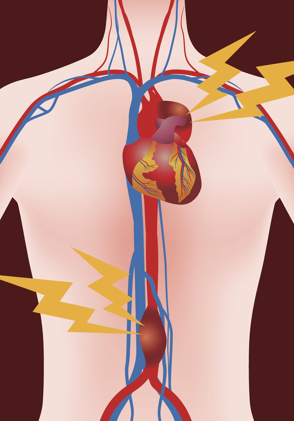 Am I At Risk for an Abdominal Aortic Aneurysm?