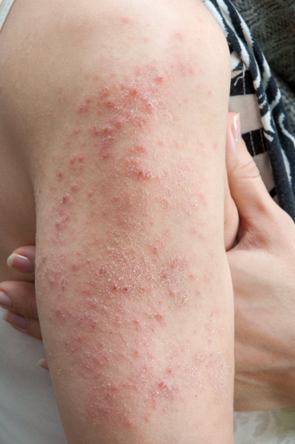 I’m Not Sure Why I Keep Getting Hives