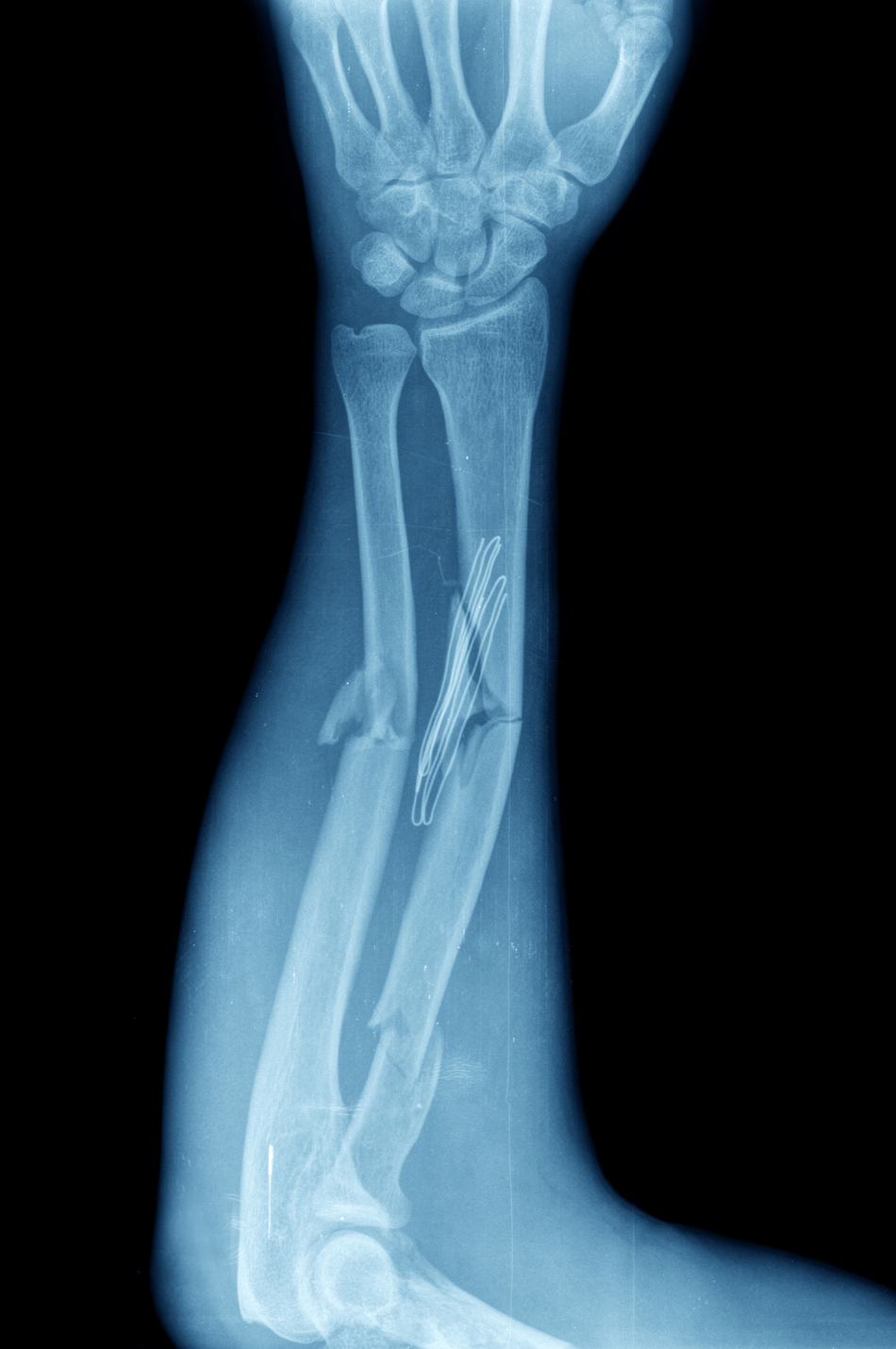 Health Hack: Use Cardboard and a T-Shirt to Help with a Broken Bone
