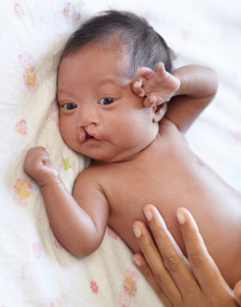 Treating a New Baby’s Cleft Lip