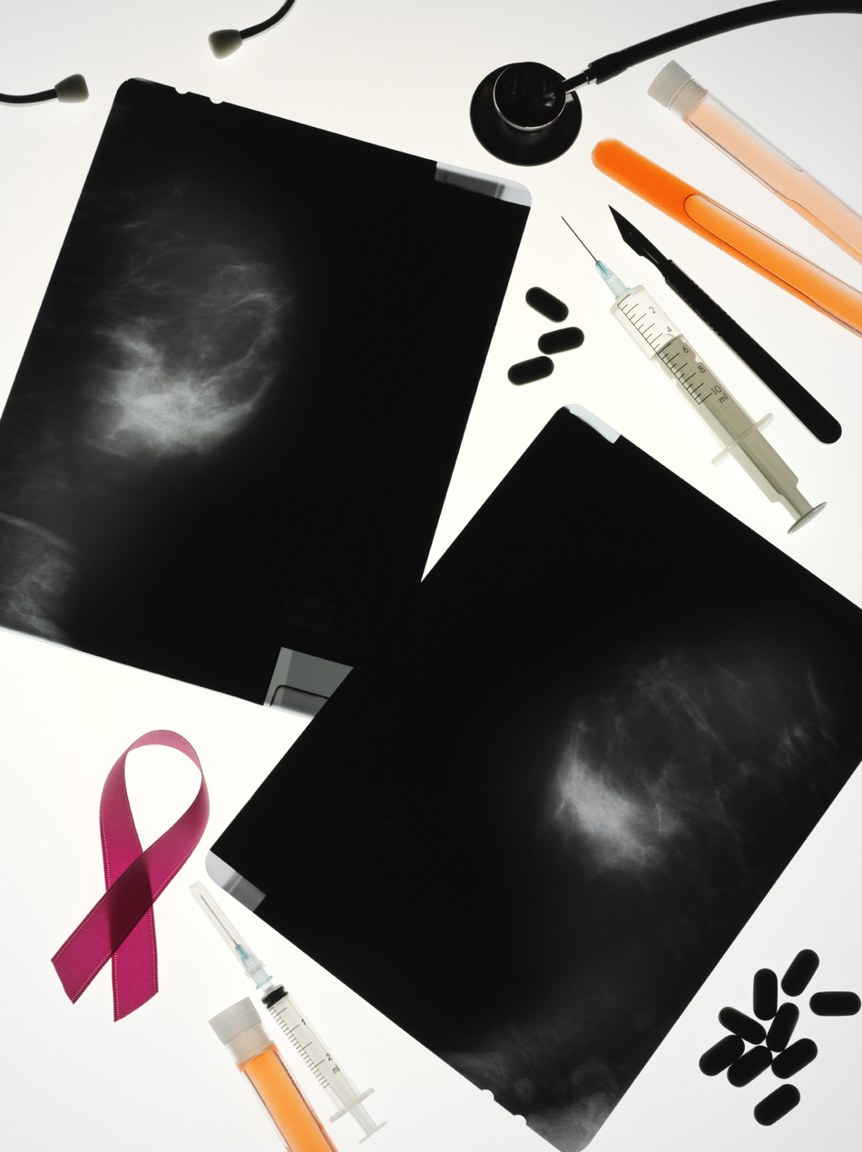 Am I Normal: My Mammogram Results Say I Have Dense Breast Tissue