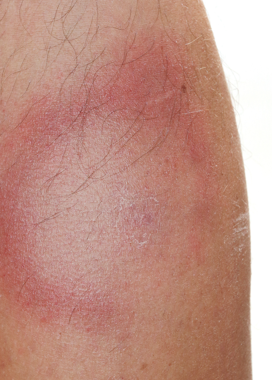 What Is Lyme Disease?