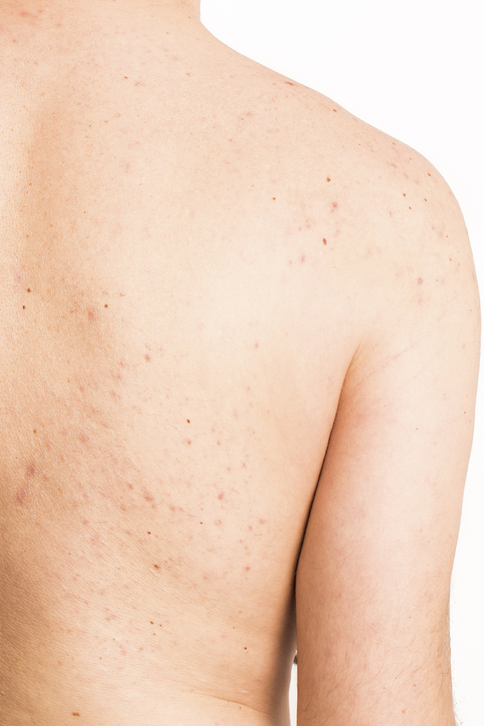 What Is HHT and Might I Have It?