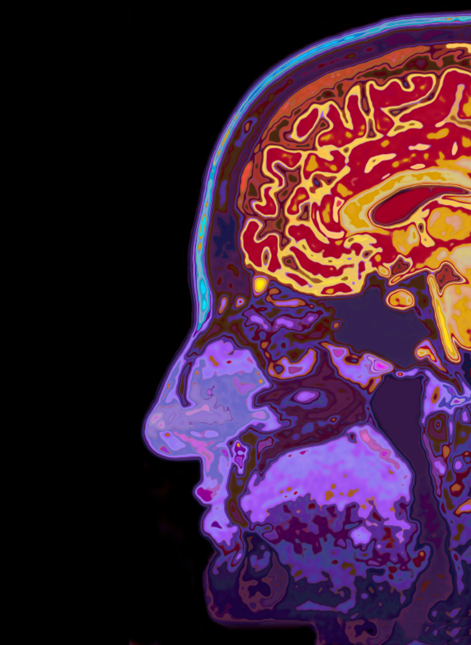 Dementia with Lewy Bodies