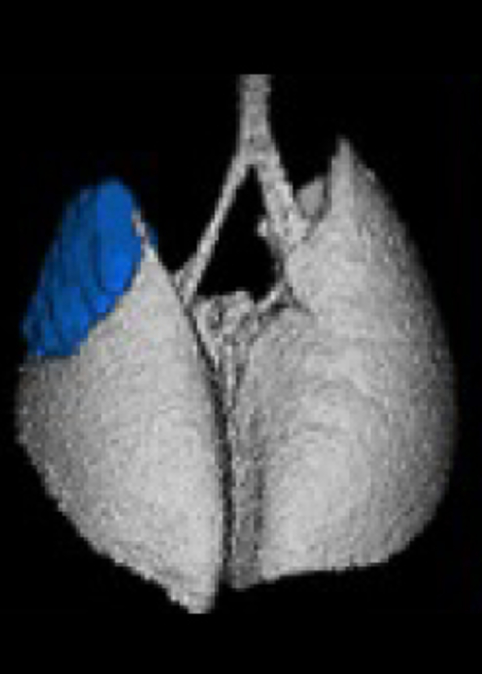 A New Tool to Confront Lung Cancer