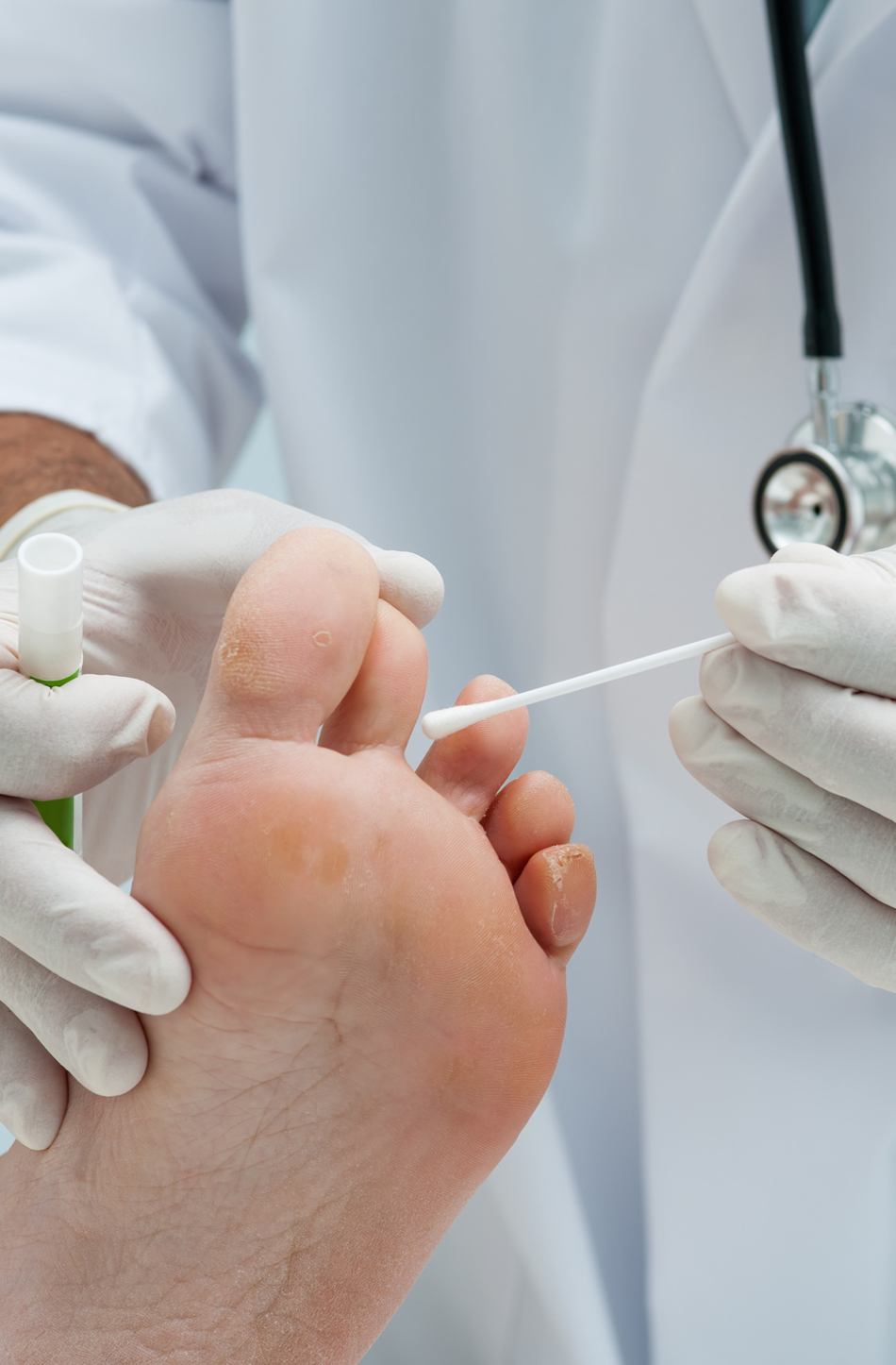 Best Ways to Treat a Nail Fungus