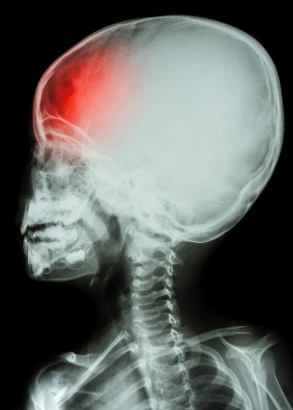 How Do I Know if My Child Has Craniosynostosis? 