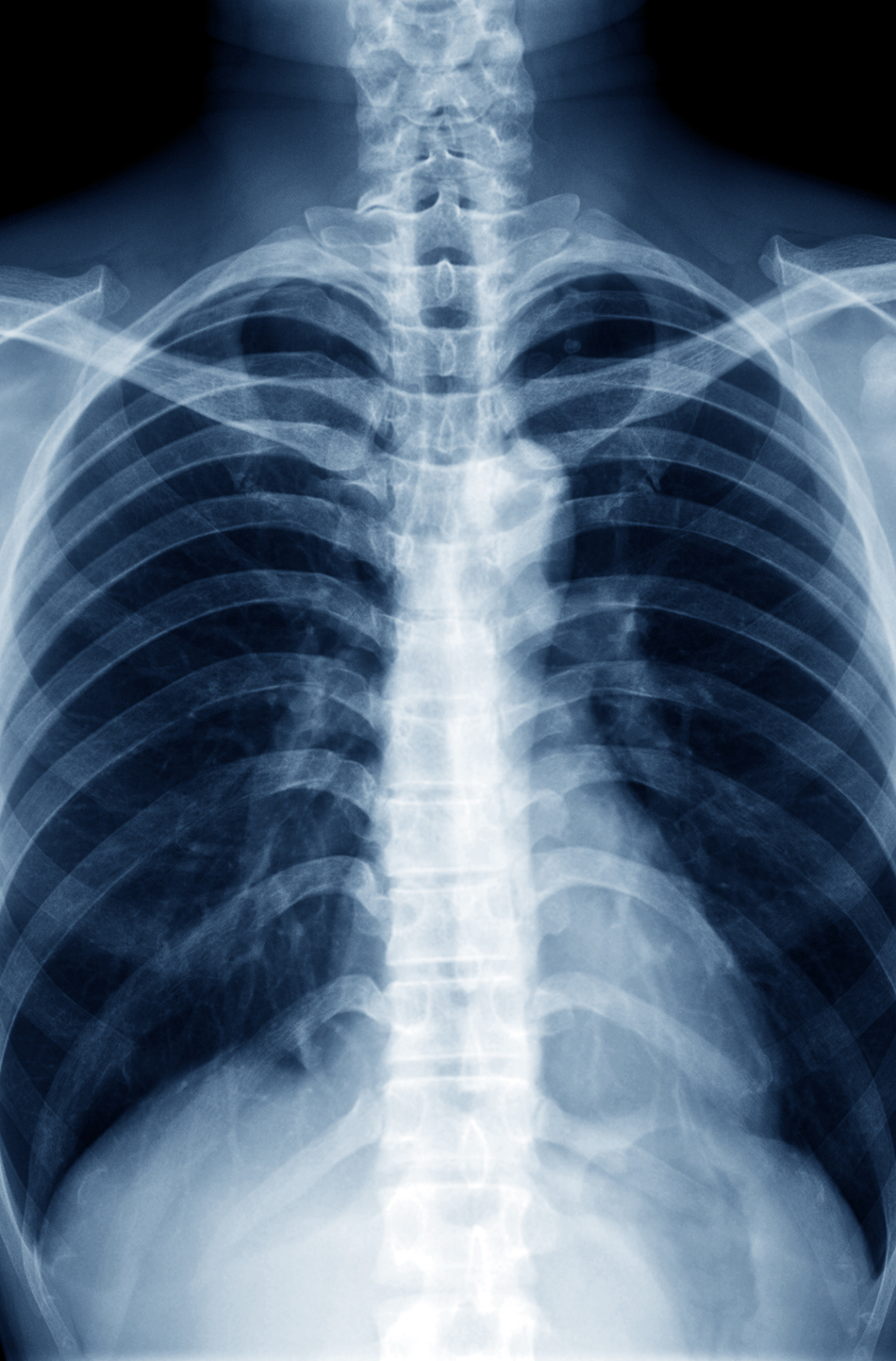 What Is Pigeon Chest and How Is it Treated?