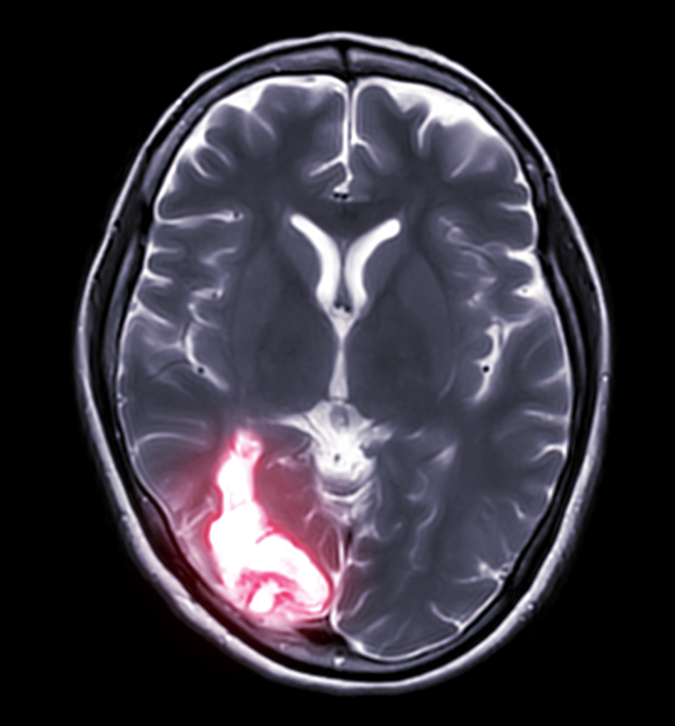 What Treatments are Available for Drug-resistant Epilepsy?