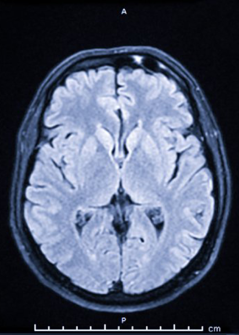 Patient Story - Zoe’s Traumatic Brain Injury