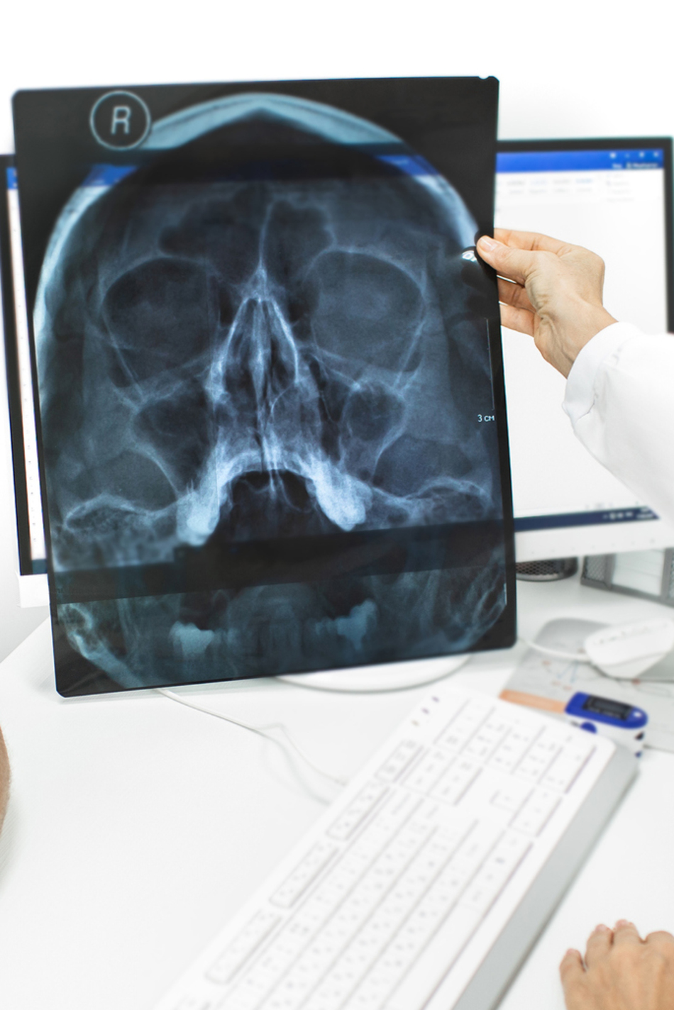 Should You Surgically Correct a Deviated Septum?