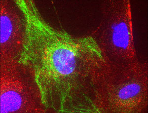Clear cell sarcoma
