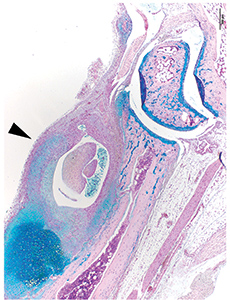 Severe Arthritis