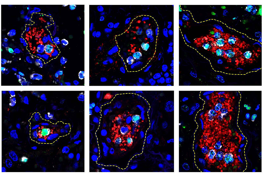 Neutrophil Extracellular Traps