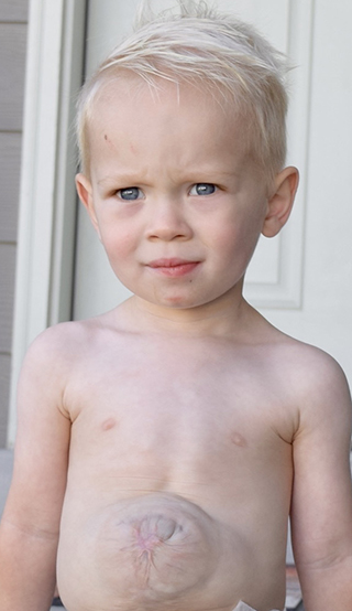 NICU patient Joseph Kleinman treated for omphalocele