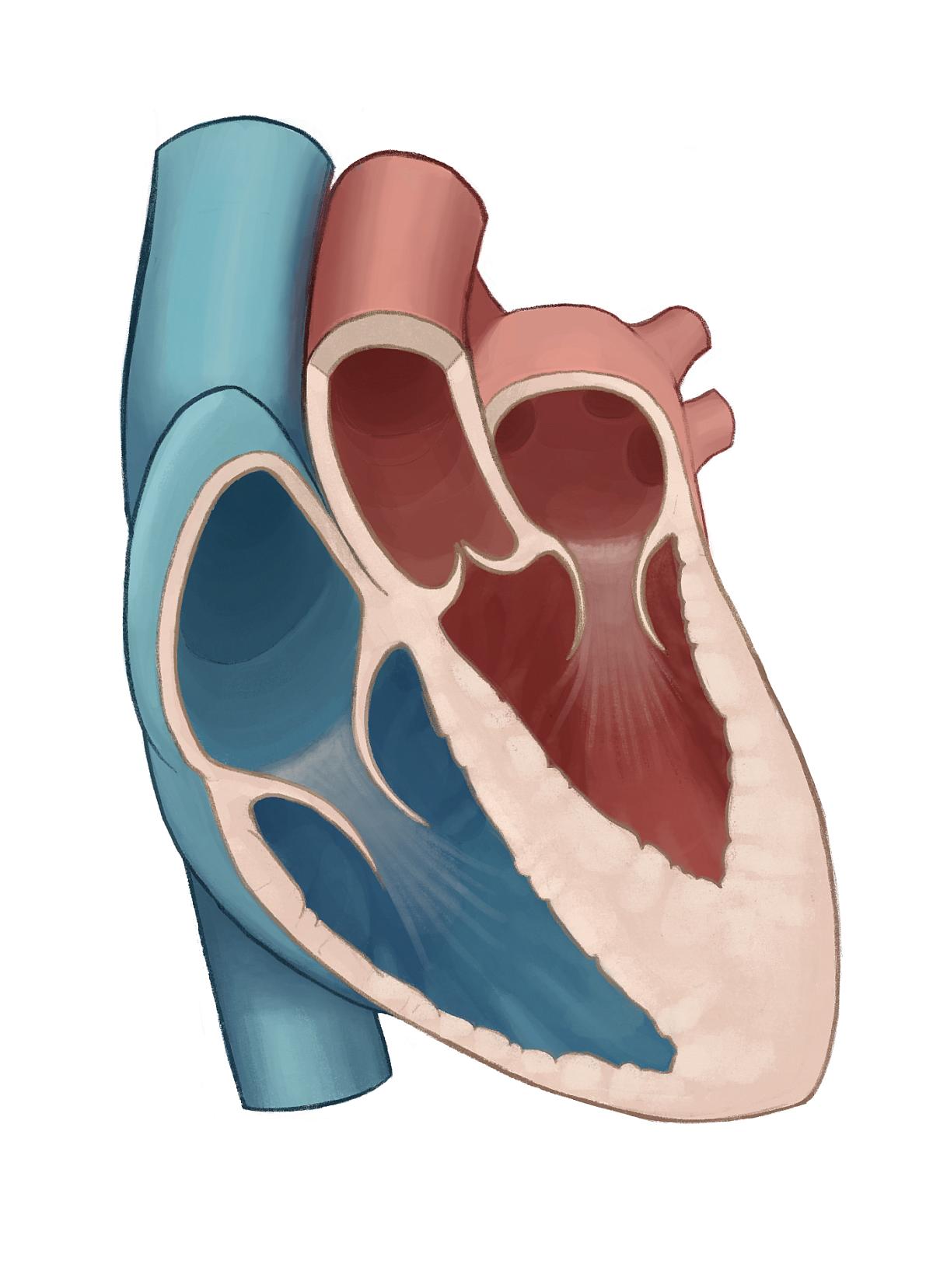 Apical hypertrophic cardiomyopathy (AHCM)
