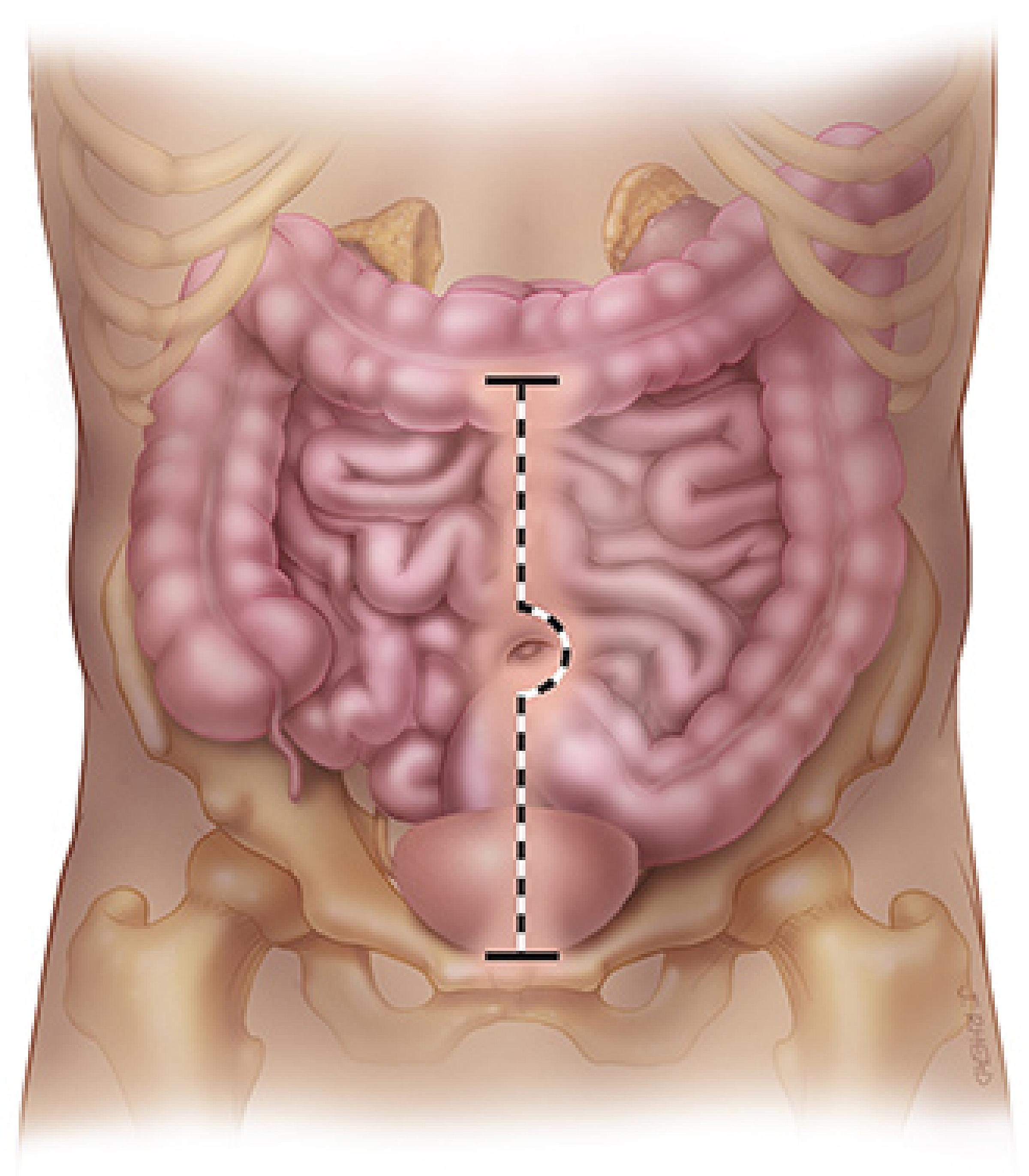 An illustration of the incision for the procedure
