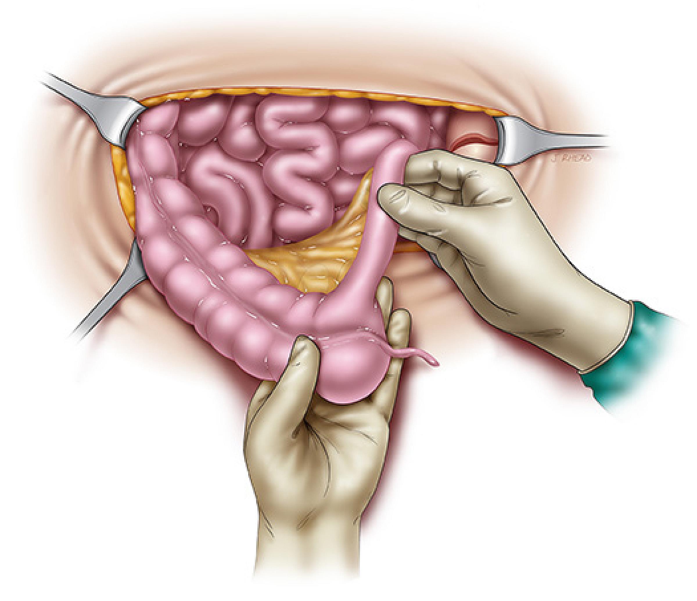 An illustration of the incision for the procedure