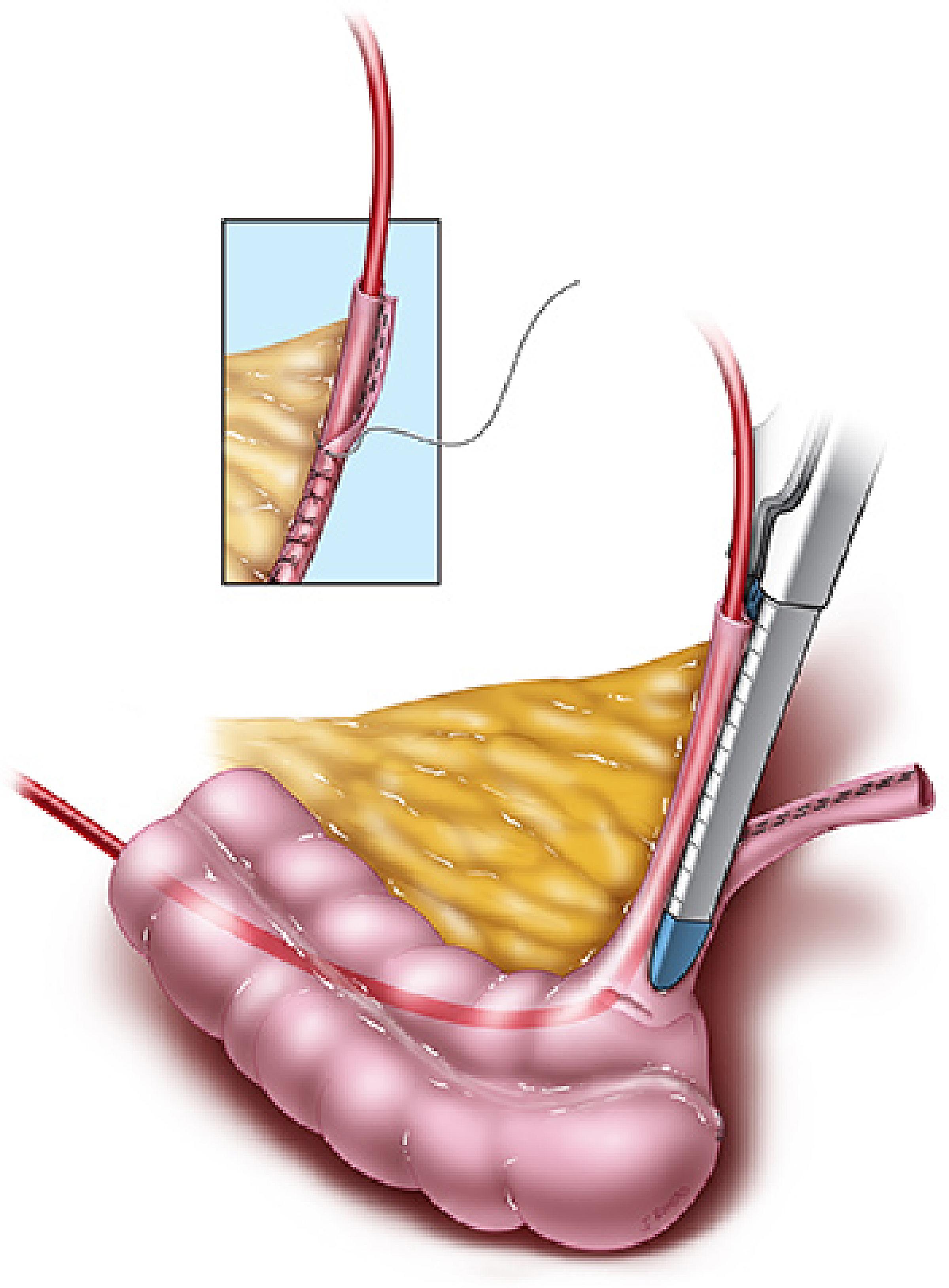 An illustration of the incision for the procedure