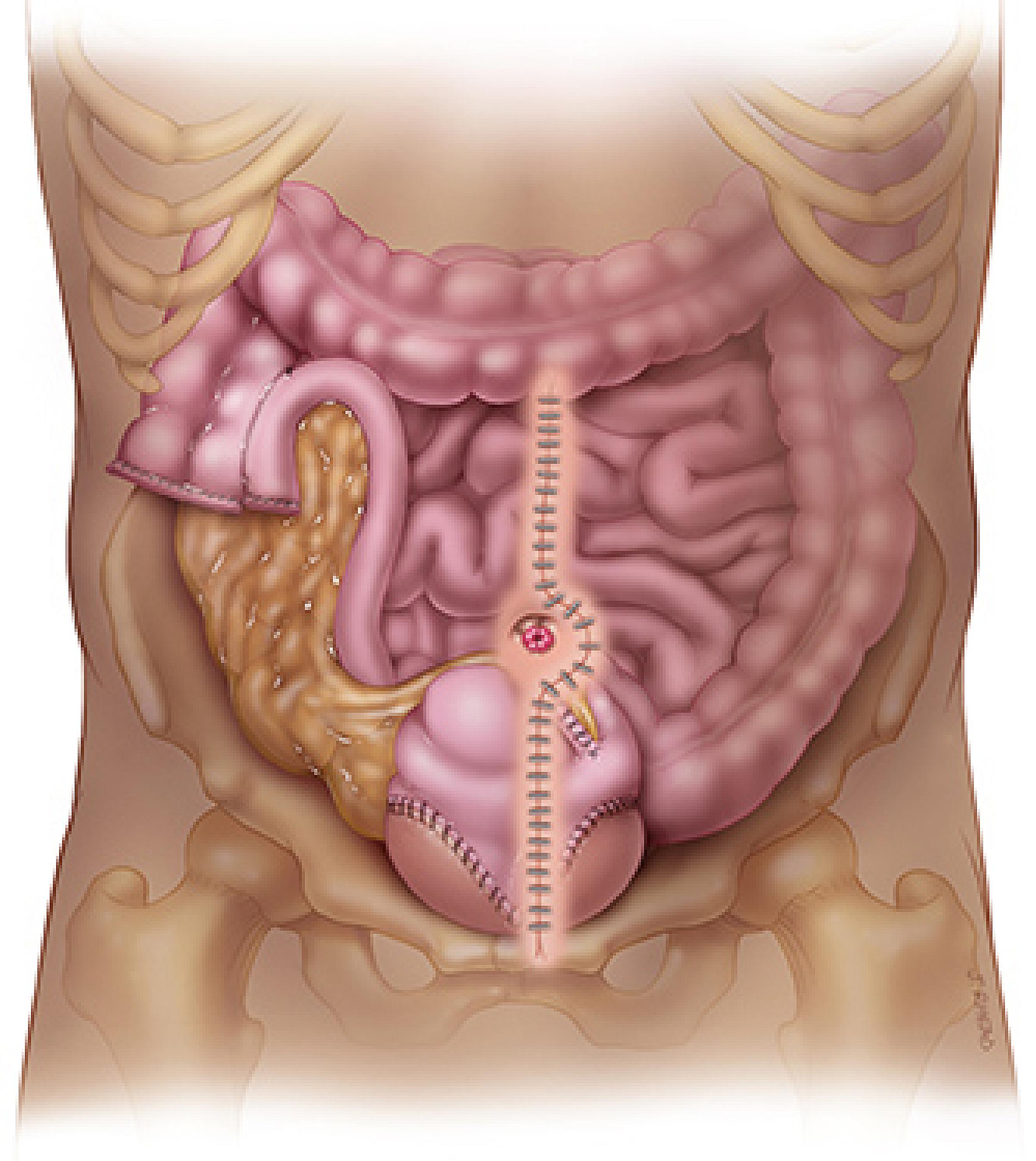 An illustration of the incision for the procedure