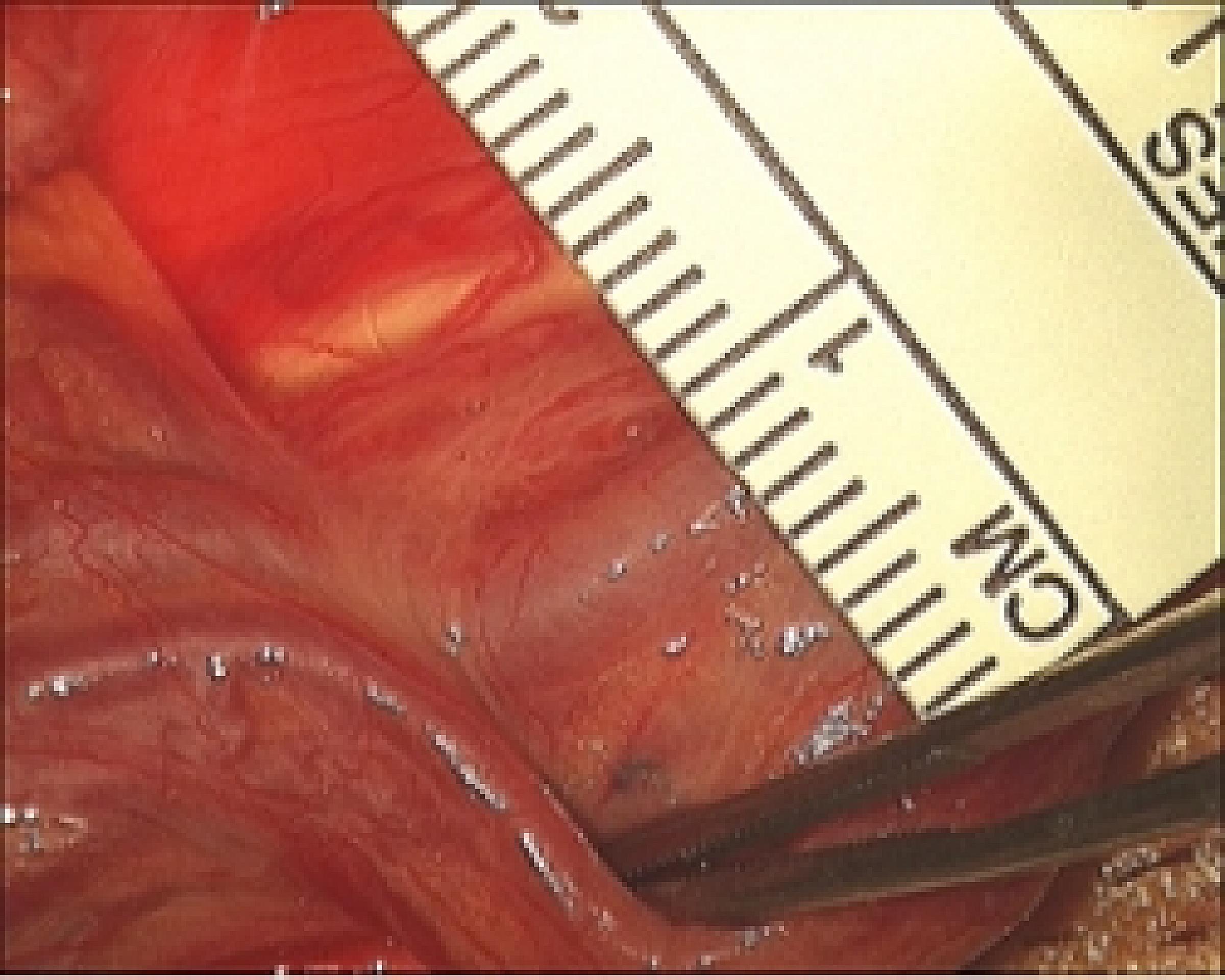 Enlarged vein next to 1cm ruler