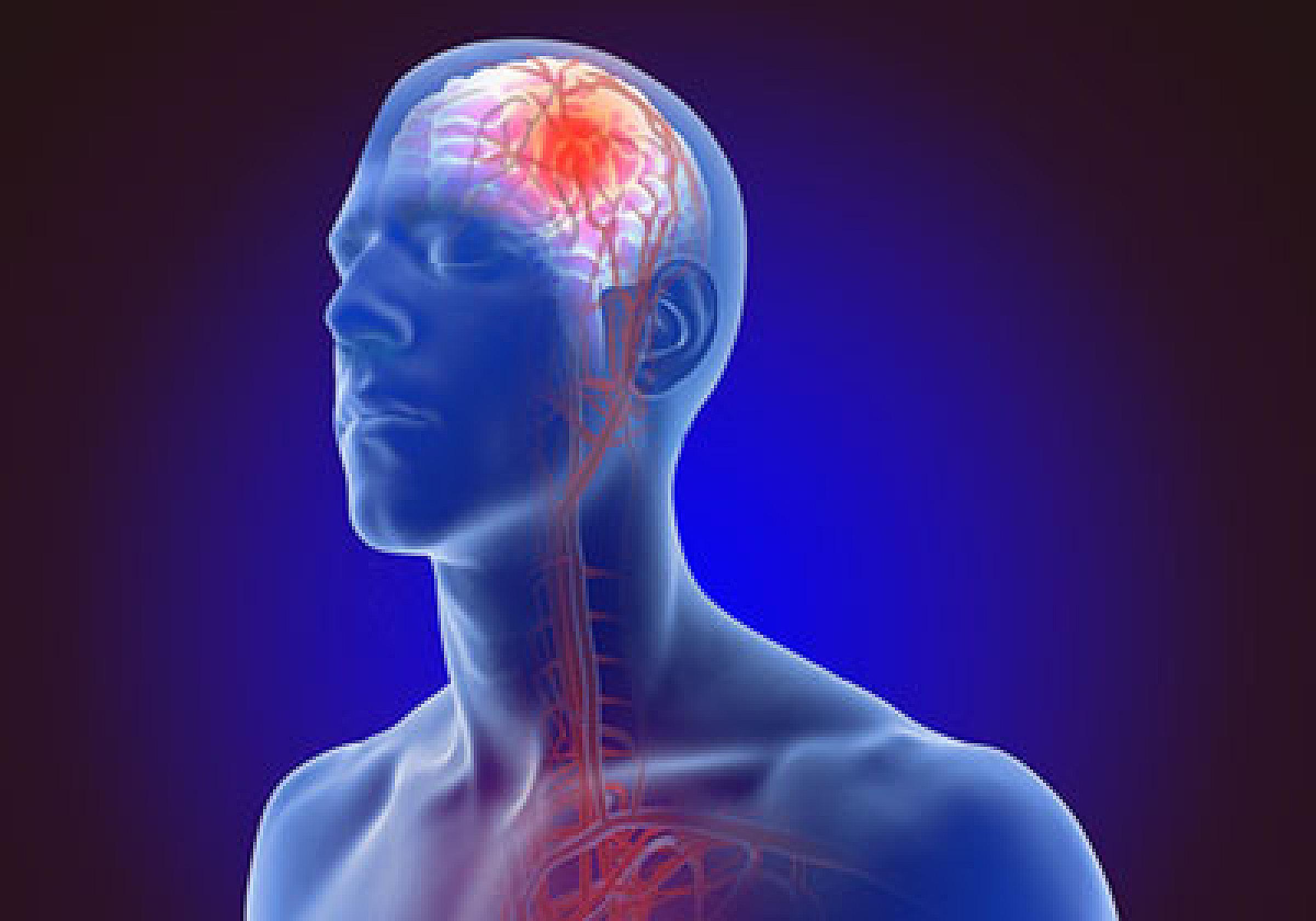 Covid stroke