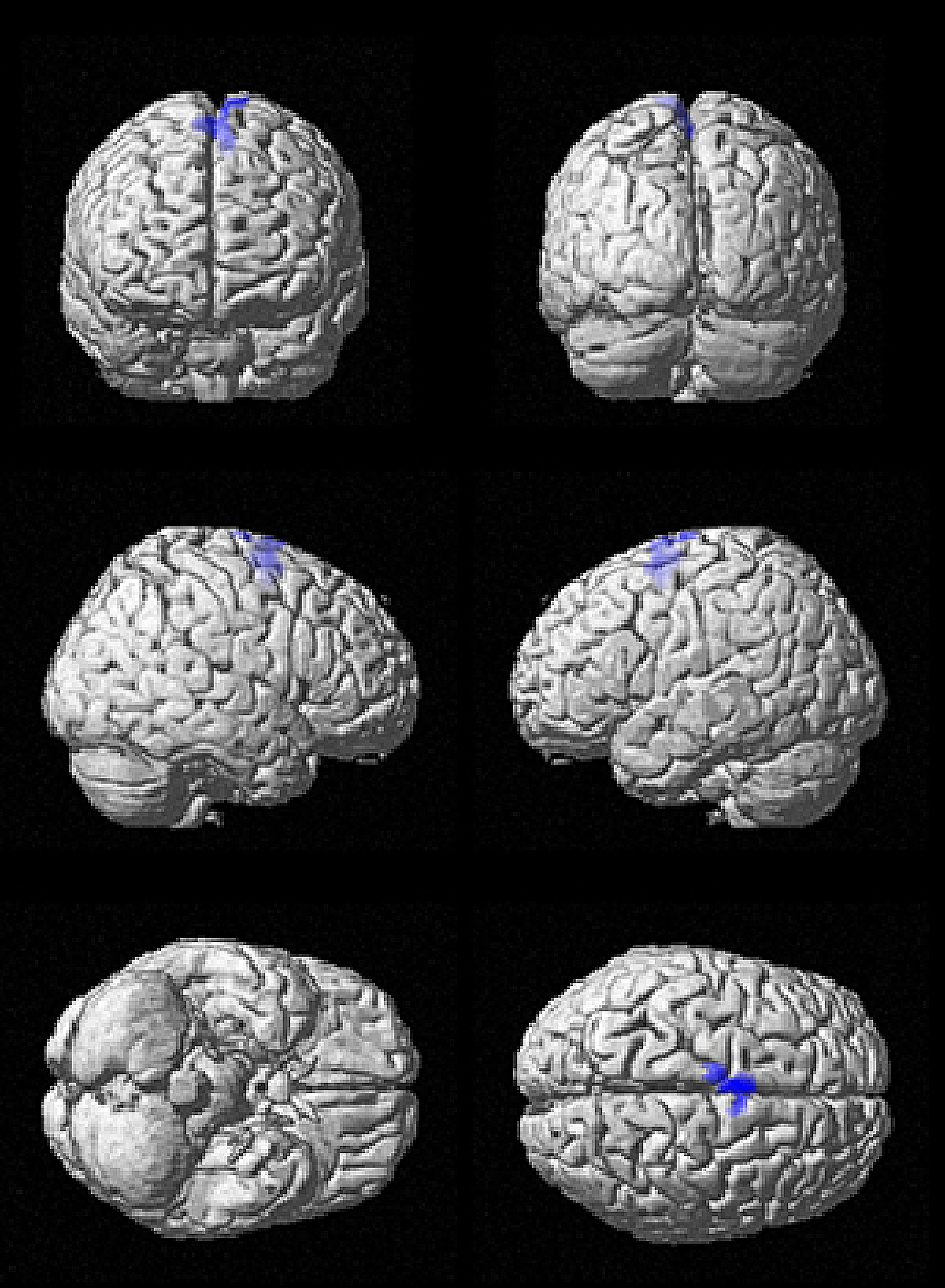 Alzheimer