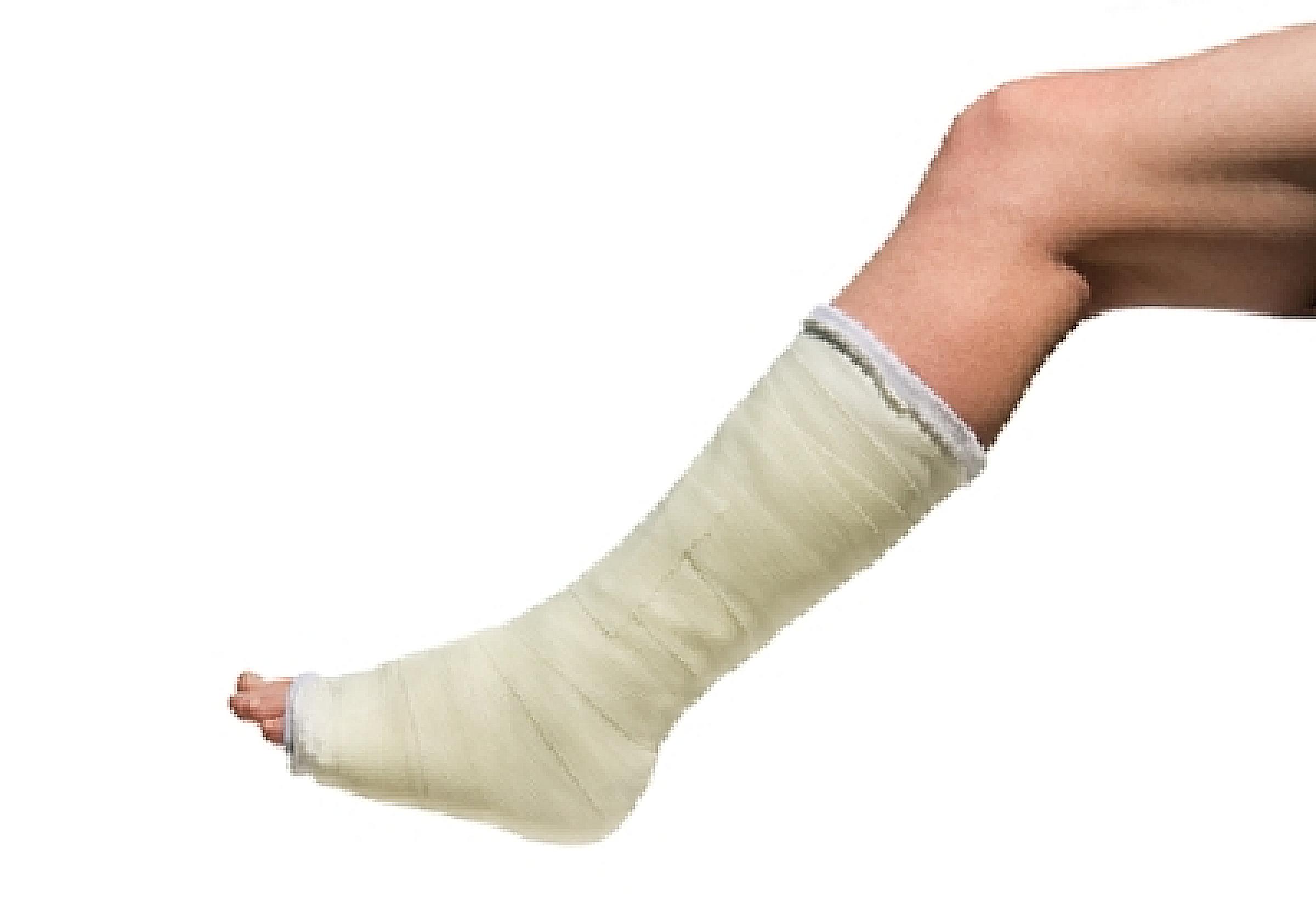 Cast on leg