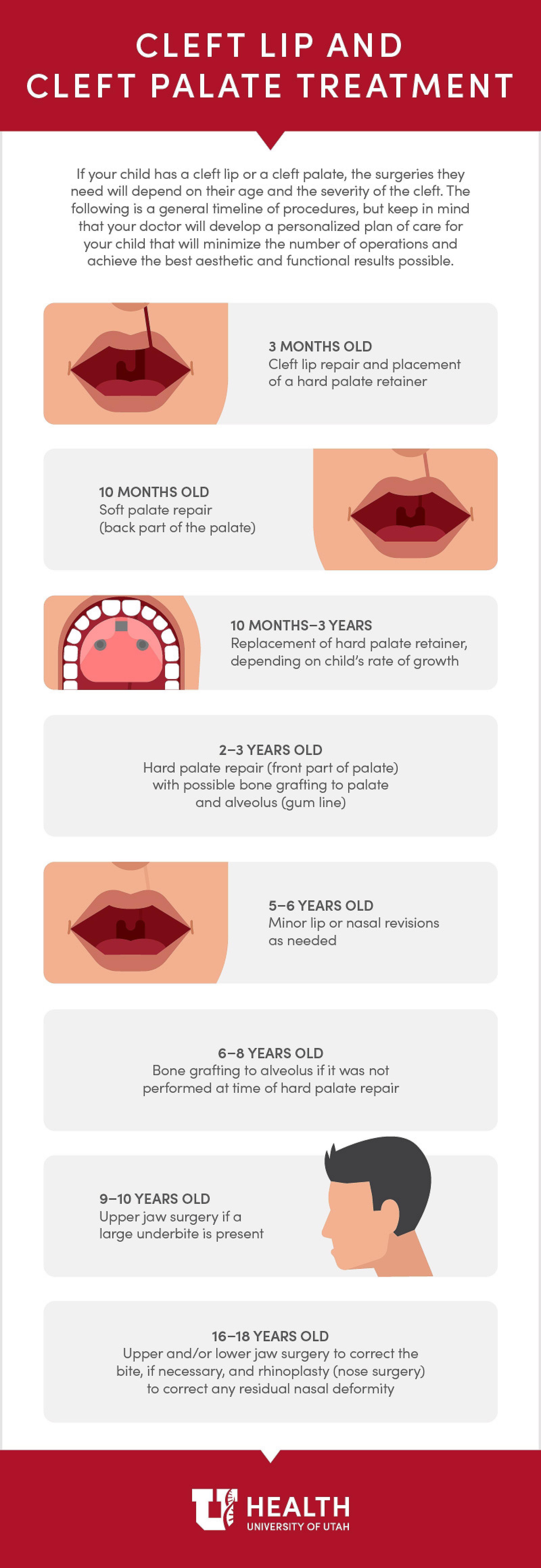 Cleft lip infographic