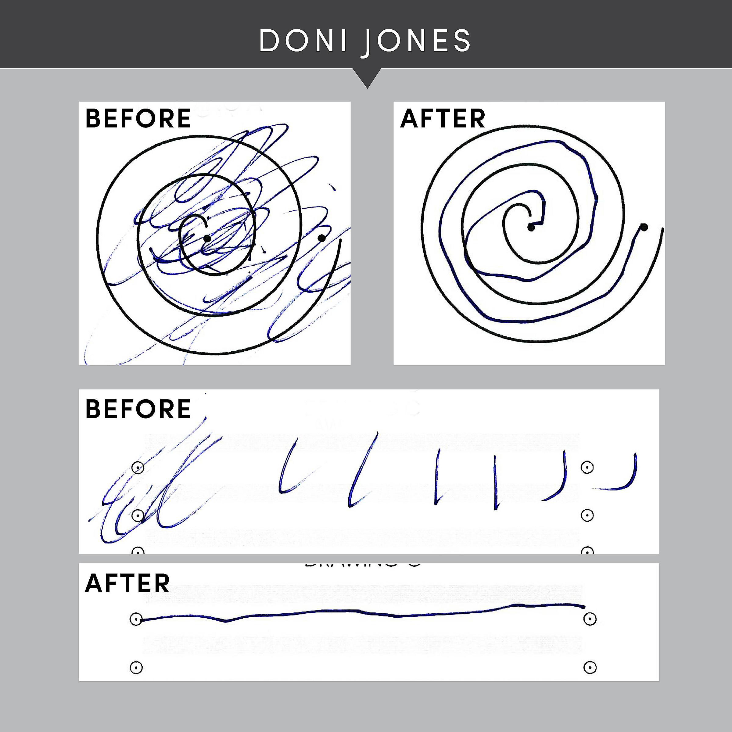 Doni Jones drawings before and after essential tremor treatment