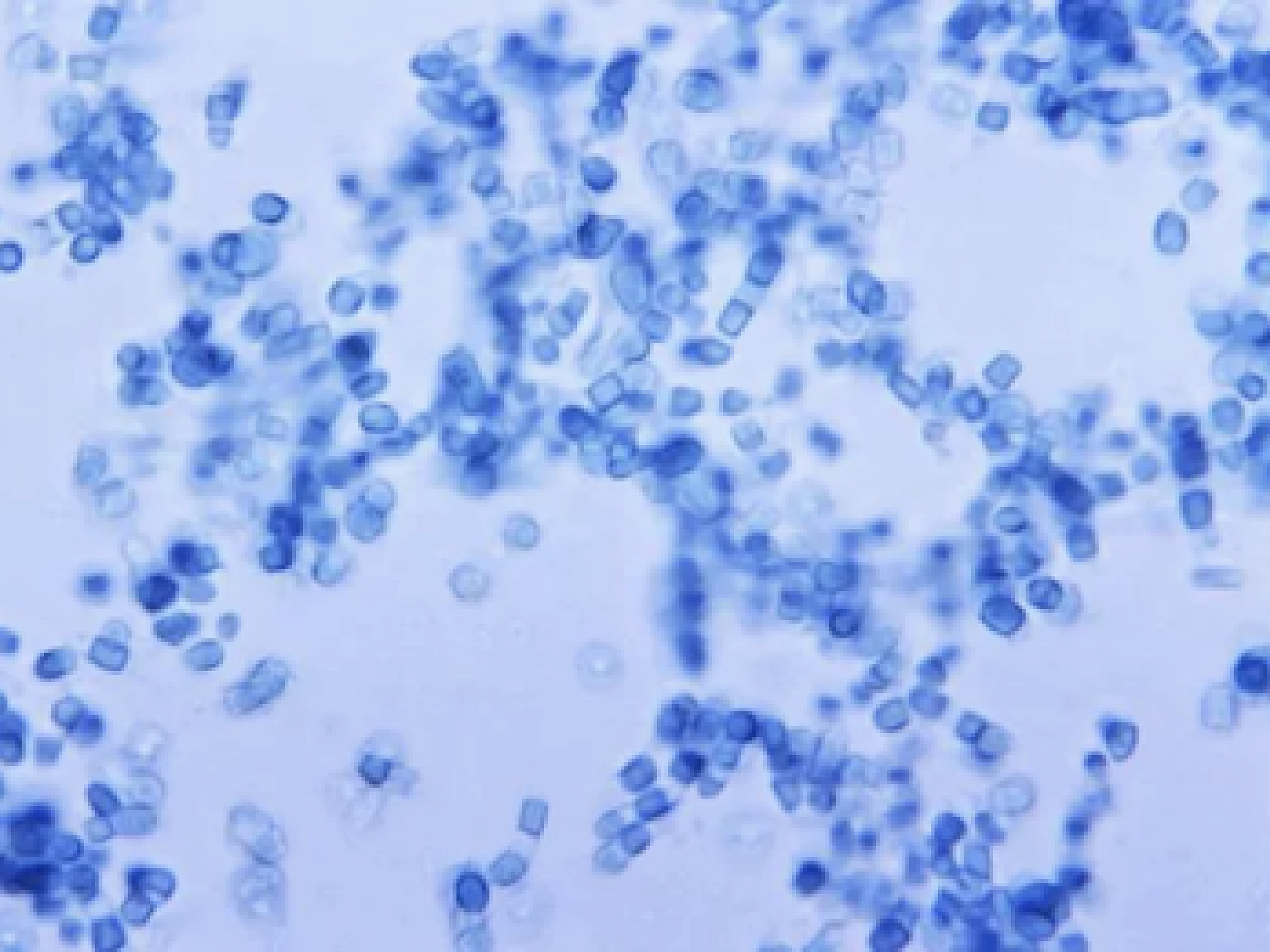 Valley Fever