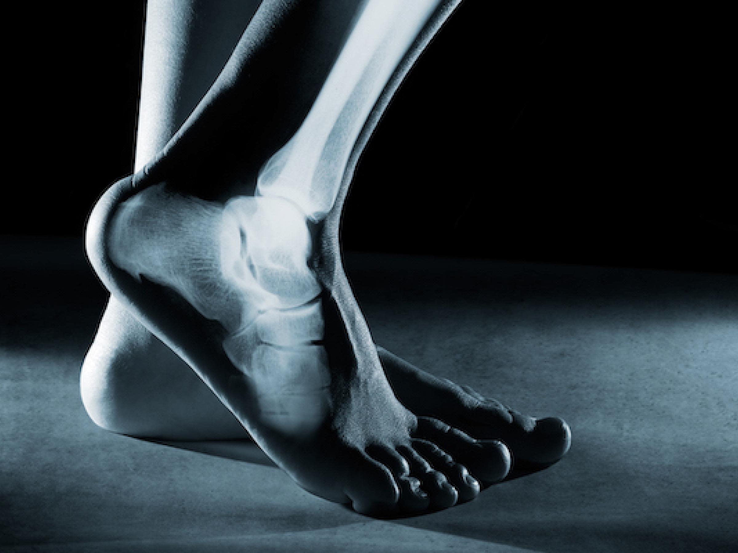 X-ray of foot bone