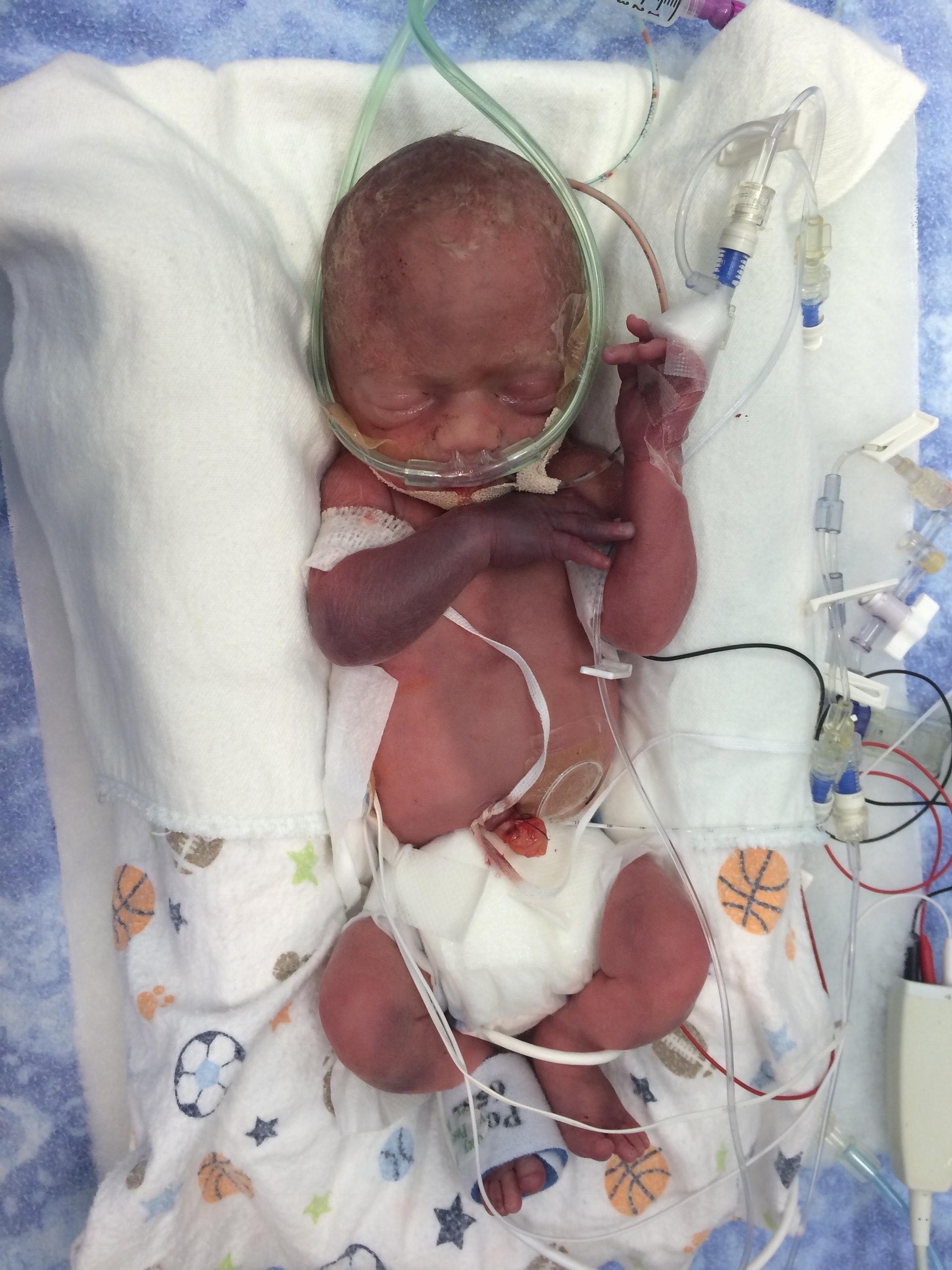Deegan Frisby, NICU patient