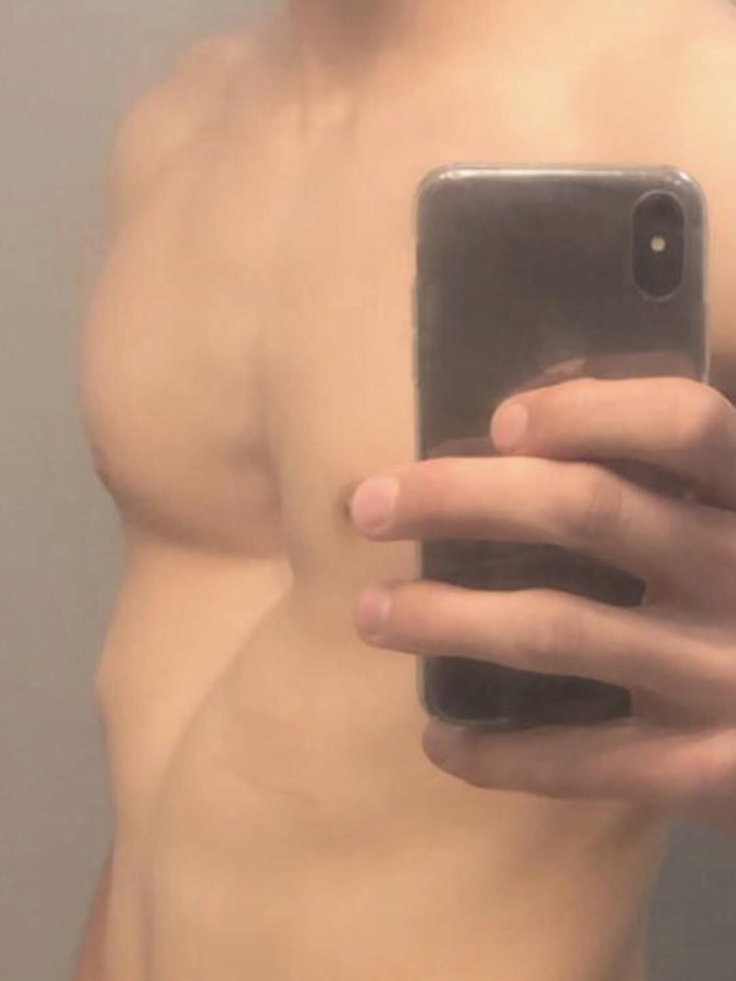 Matt Schiff, pectus excavatum patient, before Nuss procedure