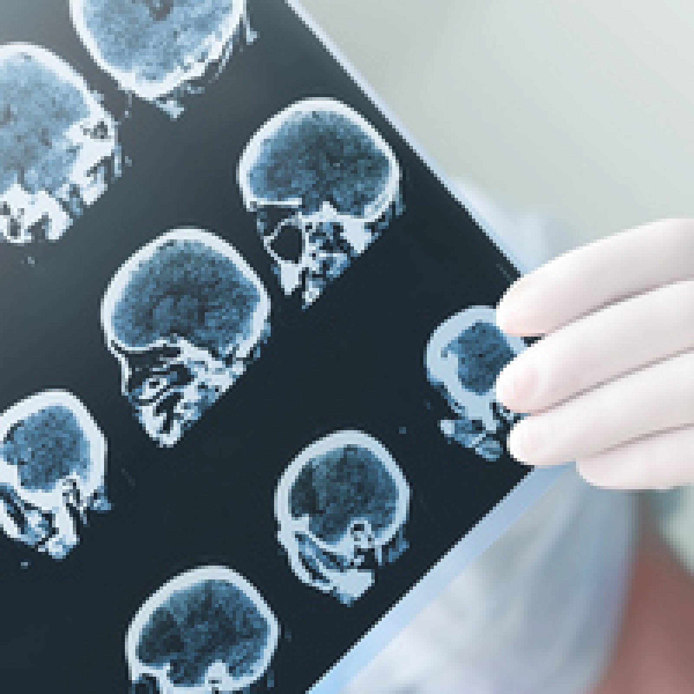 Meningioma Imaging