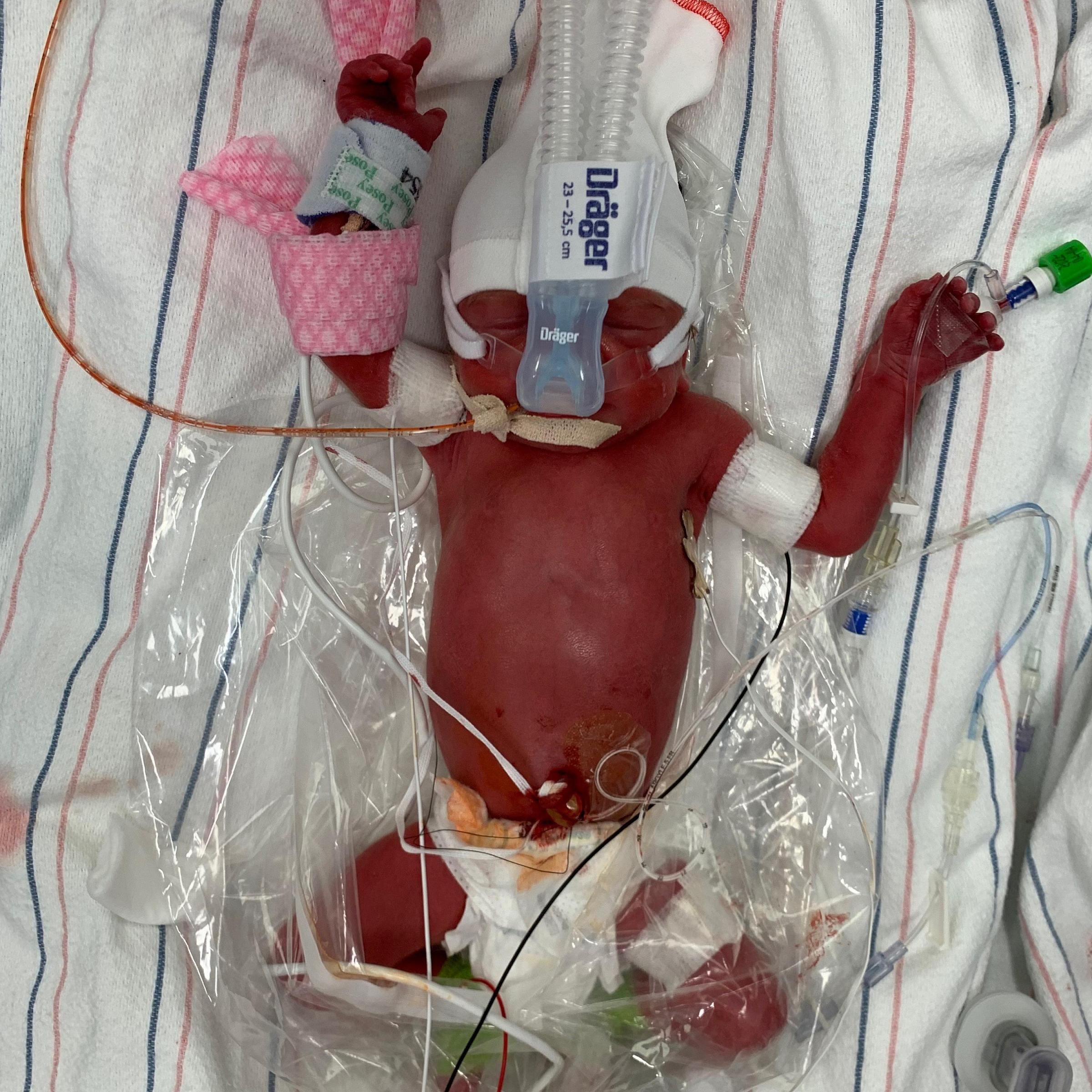 Elle Christensen, NICU Patient