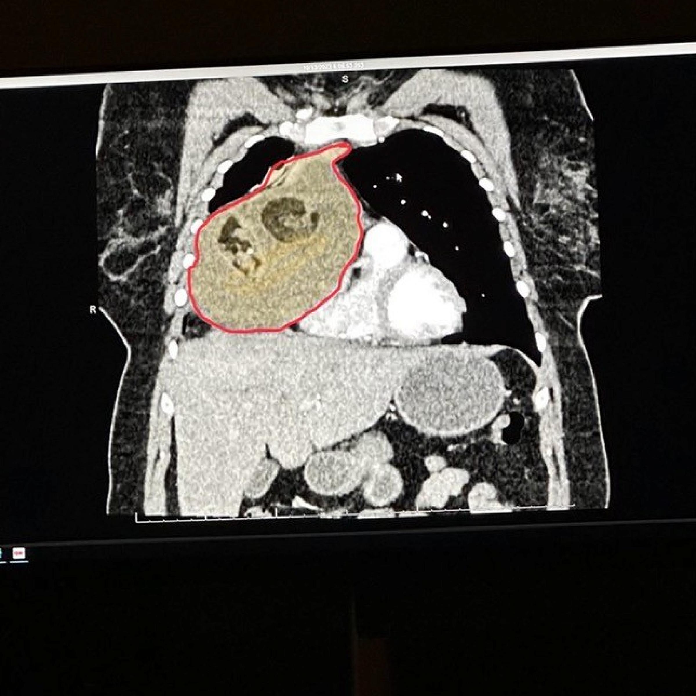Annie's tumor