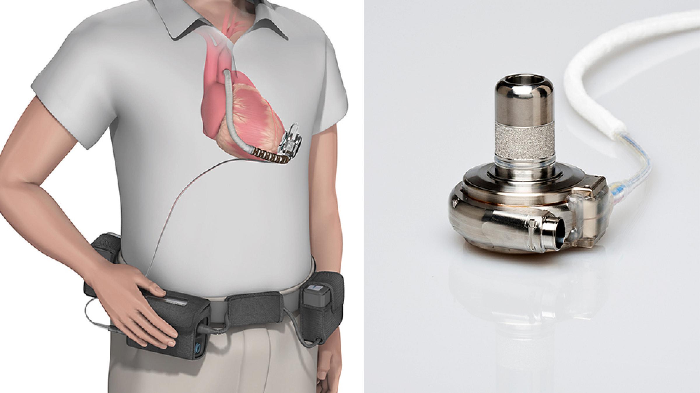 HeartWare LVAD