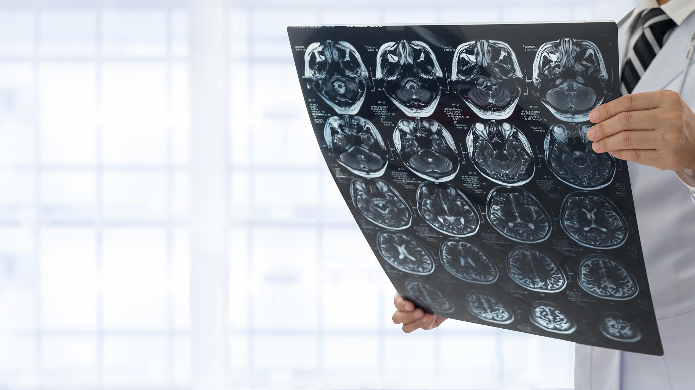 Doctor holds a brain X-ray scan.